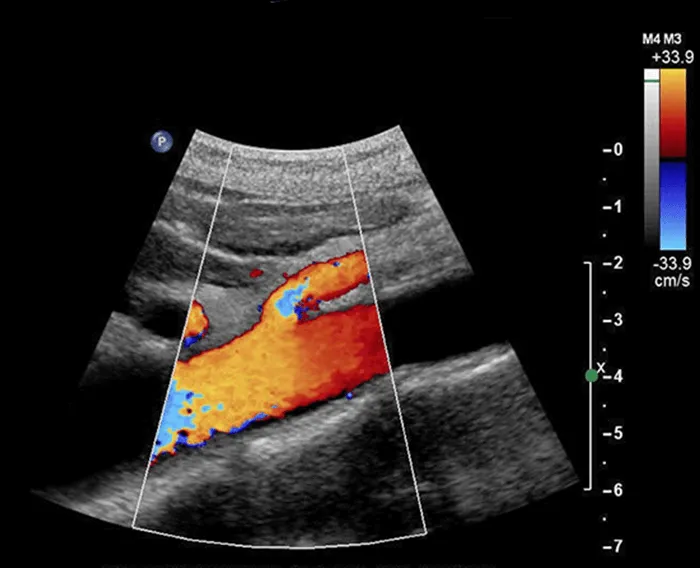 Colour Doppler