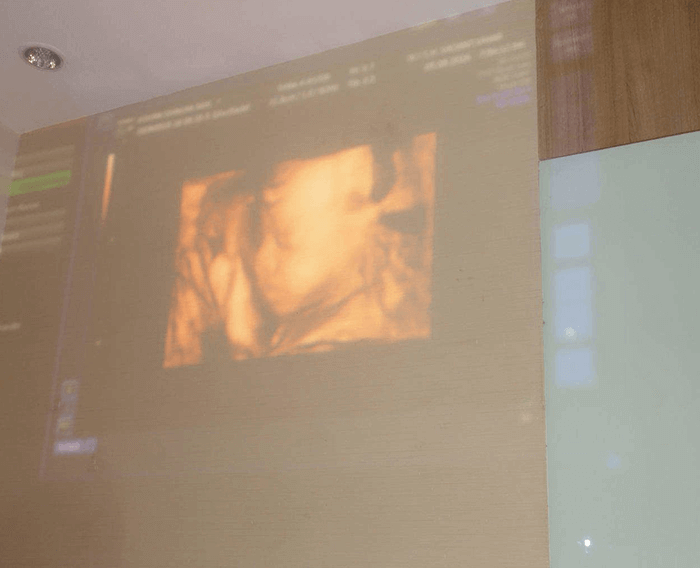 Ultrasound 3D 4D